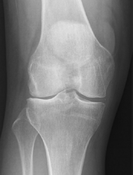 isolated lateral compartment arthritis