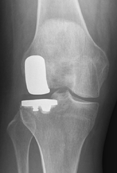 lateral compartment replacement