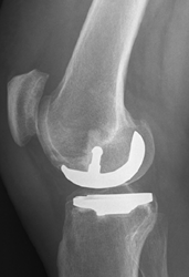 minimal posterior tibial slope