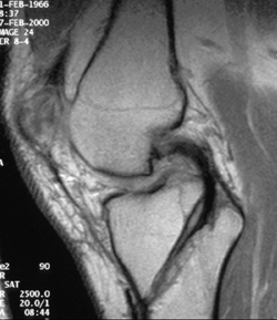 posterior tibial inlay surgical technique