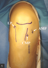 three portals utilized in double-bundle ACL reconstruction