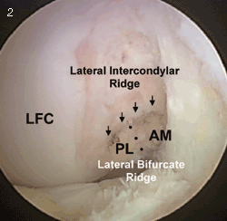 lateral wall of the notch