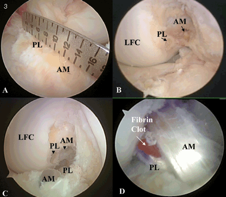 Double bundle ACL reconstruction