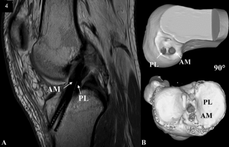 reconstructed ACL