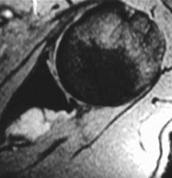 spinoglenoid notch