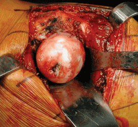 Sufficient femoral head exposure for hip resurfacing