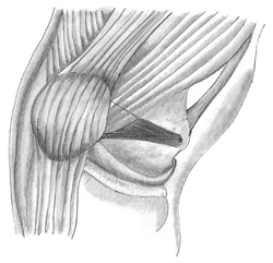 MPFL reconstruction