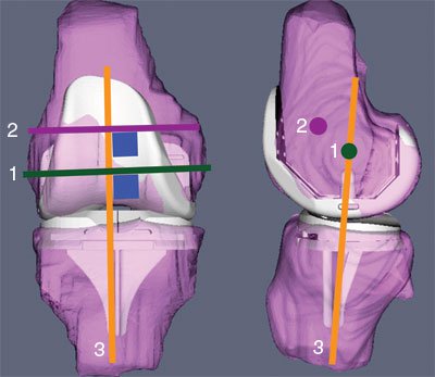 AP view and lateral view of the right knee shows the interrelationship between the three axes that define the kinematics of the knee.