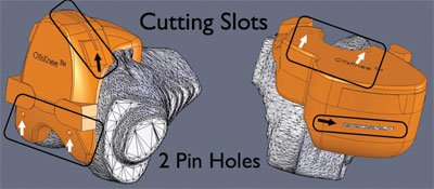 Anterior-posterior view of the femoral cutting guide