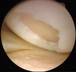 Lesion of the medial femoral condyle