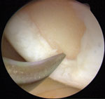 Lesion with an area of good enough bone quality for microfracture