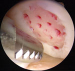 Lesion with an area of good enough bone quality for microfracture