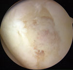 Lesion of the medial femoral condyle with more osteonecrosis