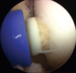 Lesion requiring a single osteoeochondral autograft