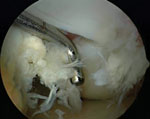 Osteochondritis dessicans lesion