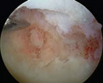 Osteochondritis dessicans lesion on the medial femoral condyle