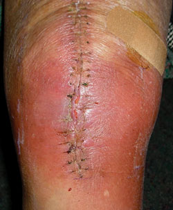 potentially infected knee