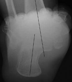 tibicalcaneal angle radiograph