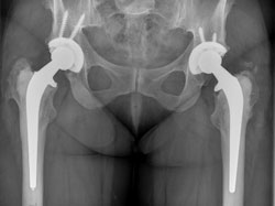 Radiograph of bilateral THA from the hybrid study at 7-year follow-up. The patient received a conventional PE liner on the left side and a highly crosslinked PE liner on the right.