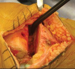 RF treatment used in the posterior compartment of the knee.