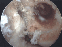 prepared femoral socket of medial femoral condyle