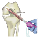 femoral implant insertion