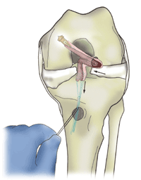 graft passage from anterolateral portal into tibial tunnel