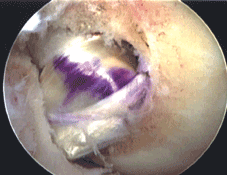 final graft position after fixation