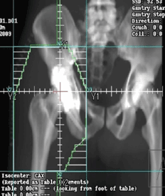 open reduction and internal fixation