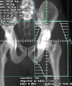 open reduction and internal fixation