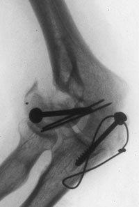 An X-ray of a combined intra- and extra- articular nonunion of the lateral column and involving the capitellum and lateral half of trochlea