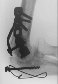 The AP X-rays 1 year following surgical treatment