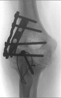 Lateral X-ray 1 year following surgical treatment