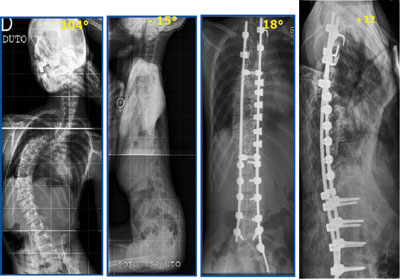 Neurological scoliosis