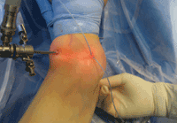 arthroscope porta