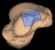  talus following transplant