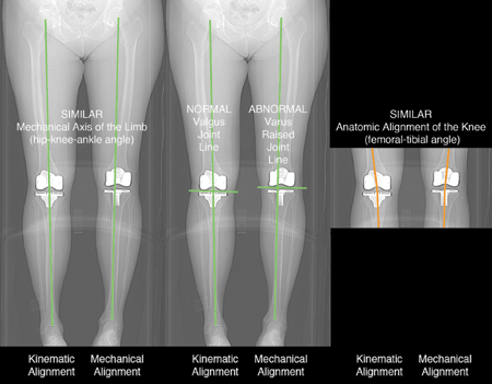 mechanical axis, joint line, anatomic alignment