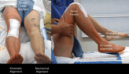 kinematic alignment outcomes