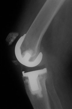 This lateral radiograph shows a displaced inferior pole patella fracture 