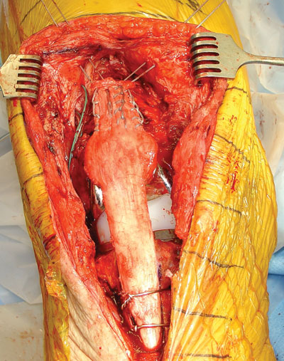 Intraoperative photo showing the extensor mechanism allograft in place.