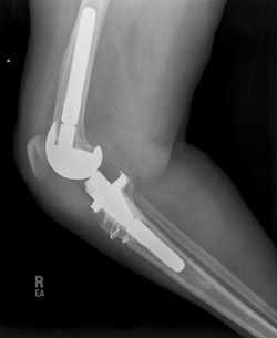 Lateral radiograph after successful extensor mechanism allograft reconstruction and revision total knee arthroplasty.