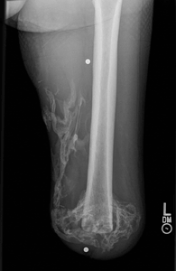  left distal transfemoral amputation