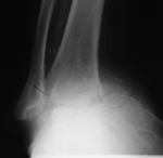 ankle of a patient with Charcot foot.