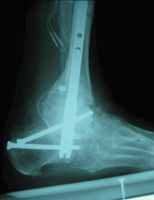 Foot treated with nail following removal of external fixator