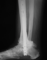 Lateral radiograph of foot treated with IM nail only