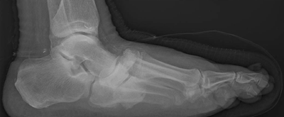 Weight-bearing radiograph of a representative foot with Charcot arthropathy in the study population