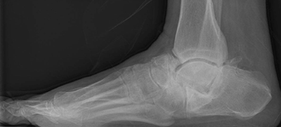 Weight-bearing radiograph of a representative foot with Charcot arthropathy in the study population