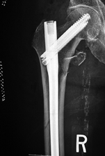 cephalomedullary device