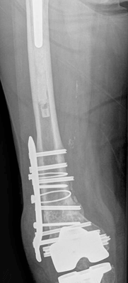 Chronic, atrophic nonunion of a periprosthetic distal femur fracture 