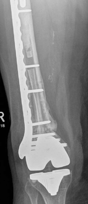 Postoperative film 1 year after revision ORIF